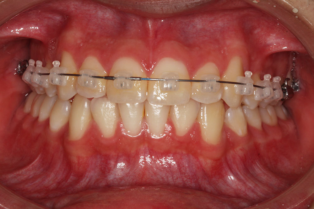 Brackets De Autoligado Estético – Odontologia En Envigado | Odontologia ...