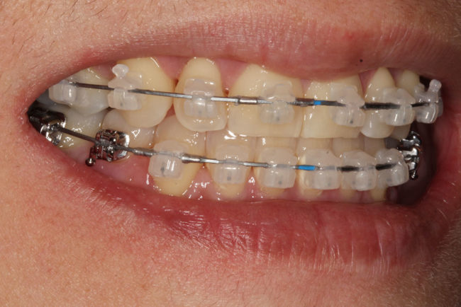 Brackets de Autoligado Estético