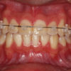 Brackets de Autoligado Estético