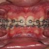 Brackets Autoligado Metálicos