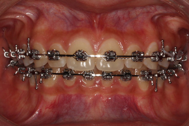 Brackets Autoligado Metálicos