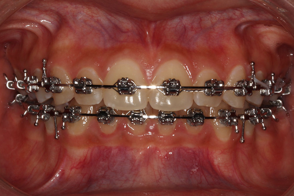 Brackets de Autoligado Metálico odontologia en Envigado odontologia en Medellin Colombia