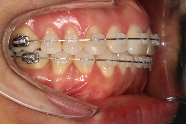 Brackets convencionales estéticos