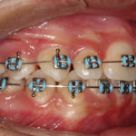 brackets metálicos convencionales Envigado