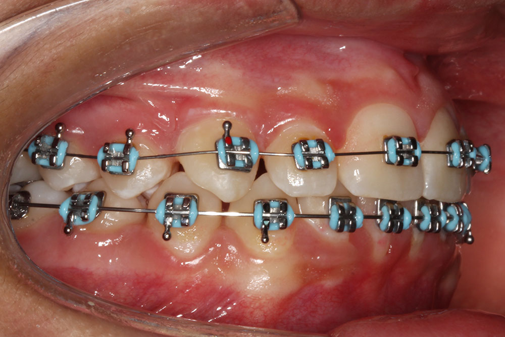 brackets metálicos convencionales Envigado