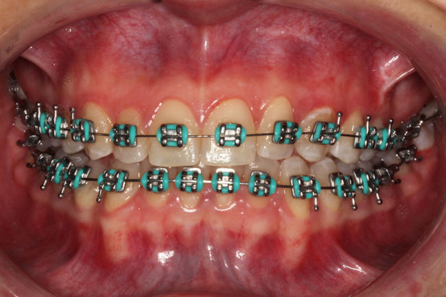brackets metálicos convencionales Medellín