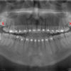 Extracción de Cordales | sacada de dientes |Exodoncia Envigado Medellin