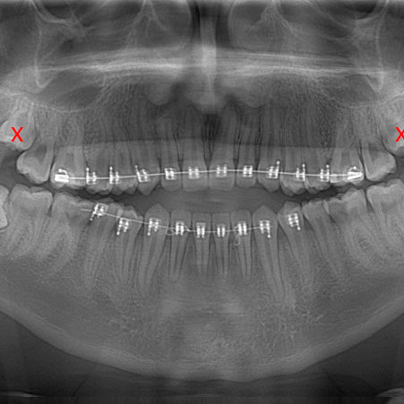Extracción de Cordales | sacada de dientes |Exodoncia Envigado Medellin