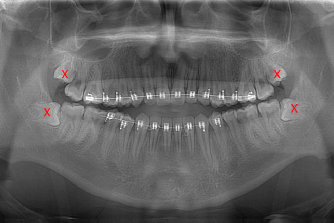 Extracción de Cordales | sacada de dientes |Exodoncia Envigado Medellin